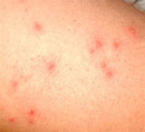 Folliculitis – Pictures, Symptoms, Causes, Treatment | hubpages