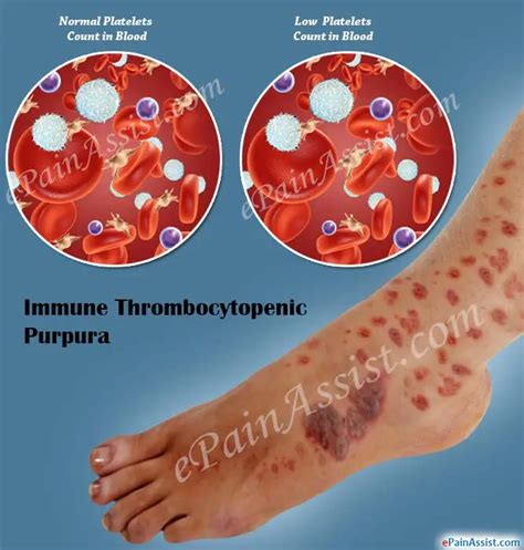 What is Immune Thrombocytopenic Purpura|Causes|Symptoms|Treatment