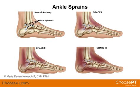 Ankle Sprain Grades