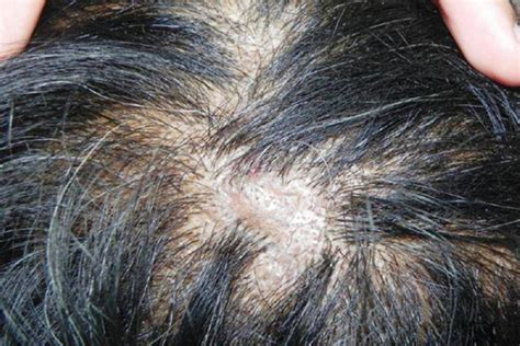 16 Natural Remedies To Say Goodbye To Scabs on Scalp (Without any Pain)