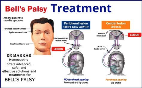 Bell S Palsy Facial Paralysis Surgeon The Facial Paralysis Institute ...