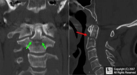 Fracture of the Dens. These are two reformatted CT images of the ...