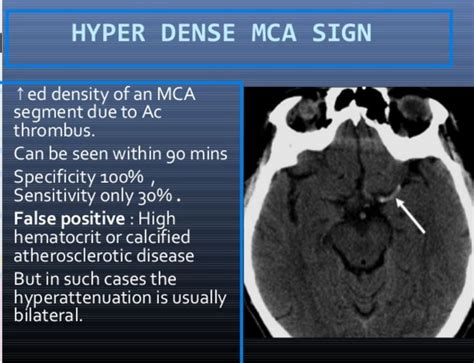 Pin by malu on ct | Signs, Mca, False positive