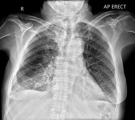 Pulmonary Edema Chest X Ray