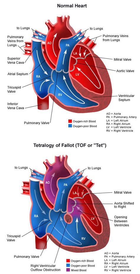 Tetralogy of Fallot | Congenital Heart Defects - Children's Hospital of ...