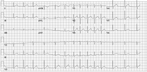 Atrial fibrillation EKG examples - wikidoc