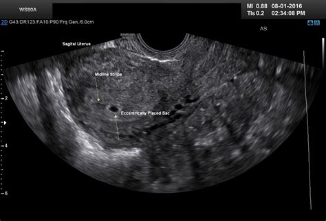 Diagnostic Ultrasound in the First Trimester of Pregnancy | GLOWM