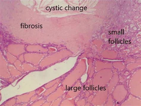 Multinodular Goiter Histology