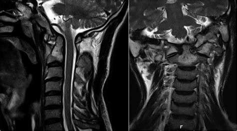 A Forty-two-Year-Old Man with Neck Pain and Abnormal Upper Cervical ...