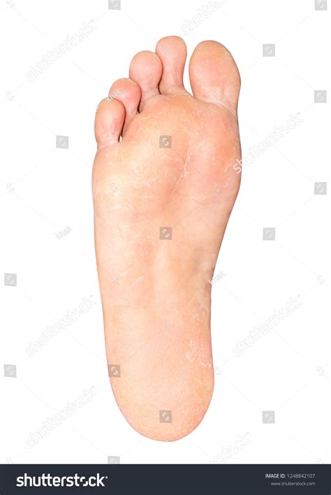 Skin Foot Peeling Due Allergic Chemical Stock Photo 1248842107 ...