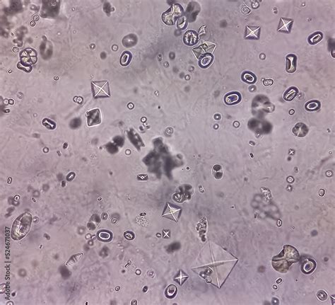 Microscopic image showing Calcium oxalate (monohydrate and dihydrate ...