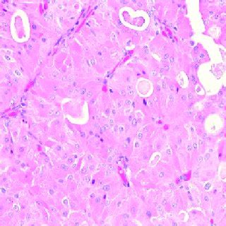 Smooth, fluid-filled lesion of medial canthus. Informed consent was ...