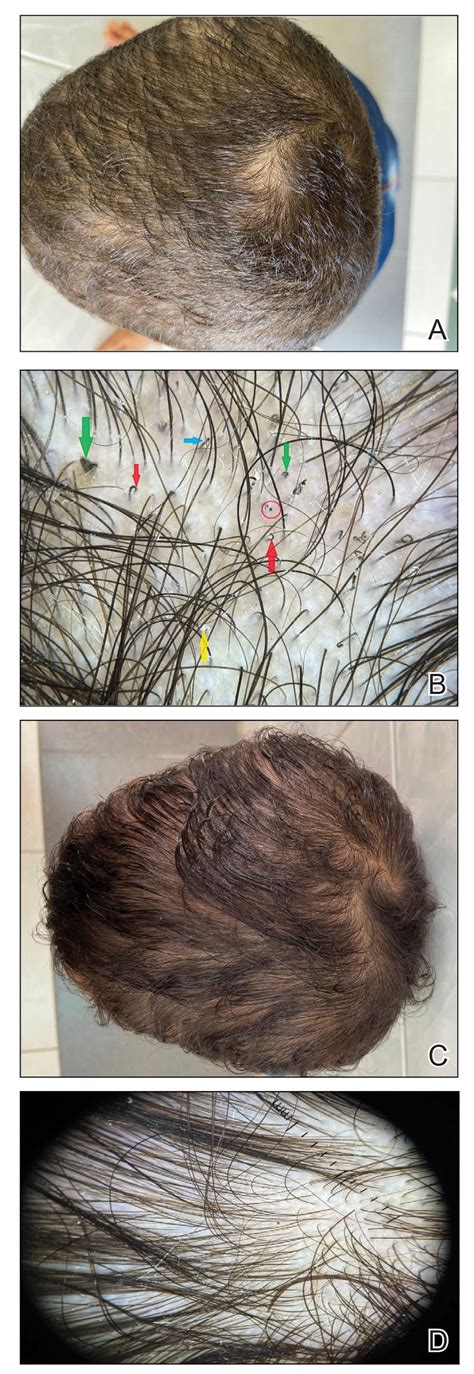 Update on Tinea Capitis Diagnosis and Treatment | MDedge Dermatology