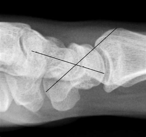 Measurement of scapholunate angle | Download Scientific Diagram
