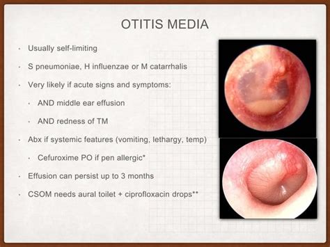 Common ear disorders