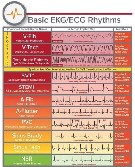 The Innovation | Medicine on Twitter: "Basic ECG/EKG rhythms #MedEd # ...