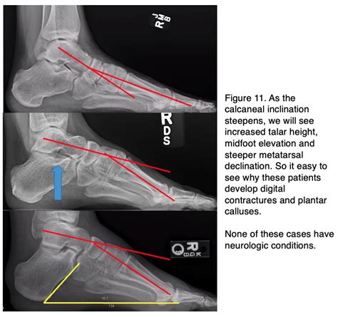 Treating Deformities in Athletes: Pes Cavus and Pes Planus | Podiatry Today