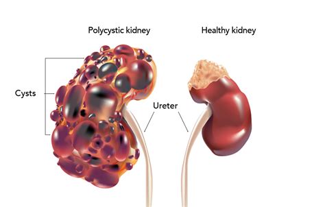 Polycystic Kidney Disease | My Doctor Online