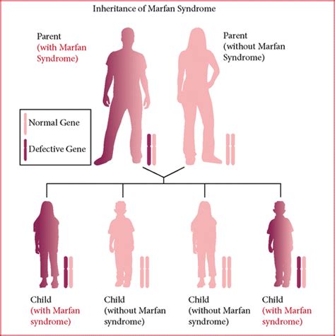 Marfan Syndrome Chromosome 15 - Captions Hunter