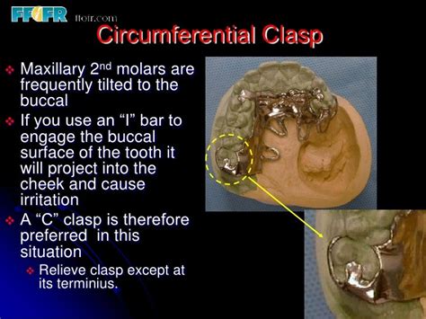 5.retainers, clasp assemblies and indirect retainers