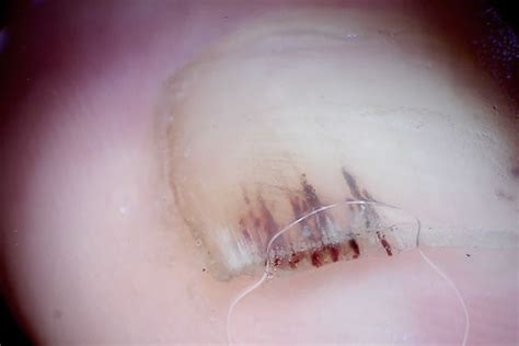 Splinter hemorrhages causes, what it looks like, diagnosis & treatment