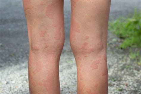 What are the signs and symptoms of hives?