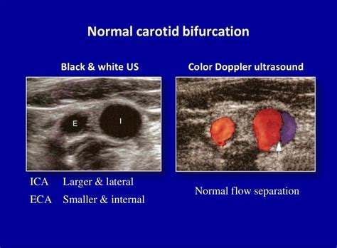 Doppler ultrasound of carotid arteries