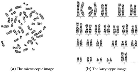 Down Syndrome Karyotype Chart