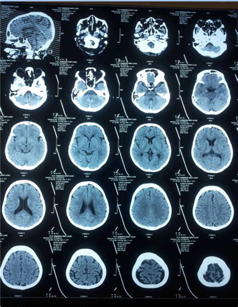 Normal Ct Brain