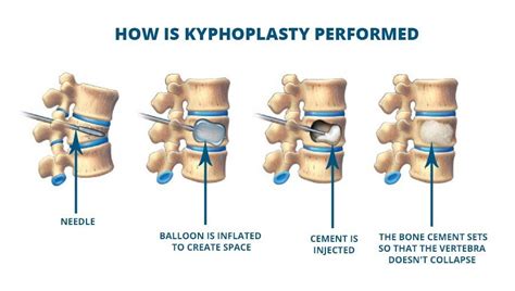 KYPHOPLASTY FOR COMPRESSION FRACTURES | Total Spine & Brain Institute