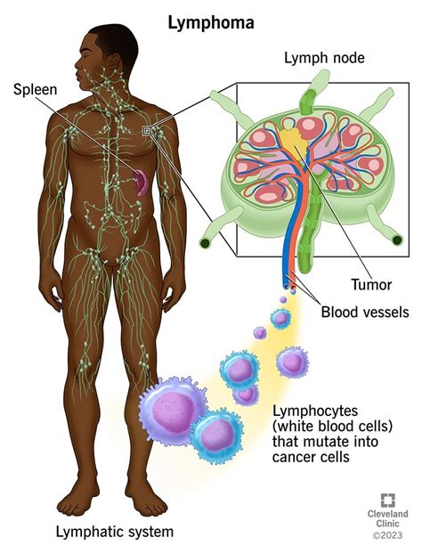 Cutaneous T-cell Lymphoma: Types, Symptoms Prognosis, 57% OFF