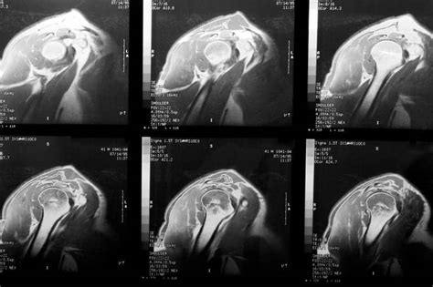 MRI Predicts Shoulder Stiffness for Rotator Cuff Tears - Axis Imaging News