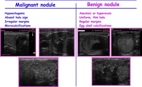 Normal Thyroid Ultrasound Nodules