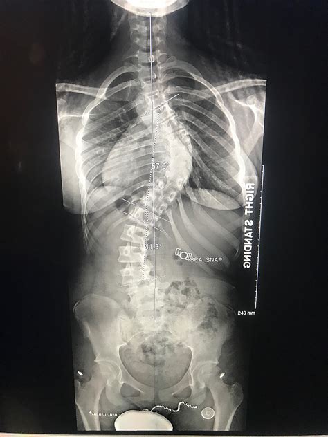 Value Proposition to a Hospital of Obtaining 36-inch Standing Scoliosis ...