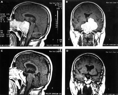 A “giant” prolactinoma | Journal of Neurology, Neurosurgery & Psychiatry