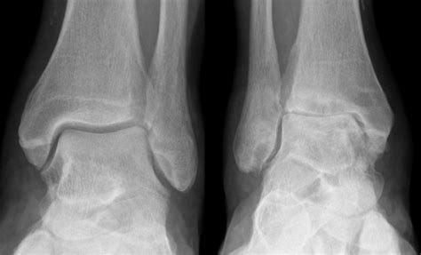 Ankle Arthritis — Ankle Arthritis | Ankle Replacement | Arthrodesis ...