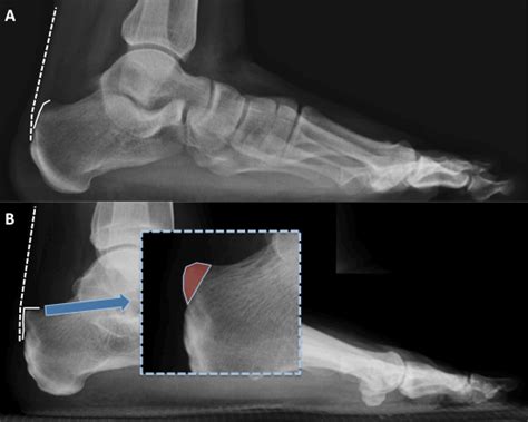 Billing and Coding Haglunds deformity or Retrocalcaneal exostectomy ...