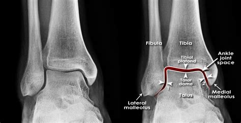 Trauma X-ray - Lower limb - Ankle