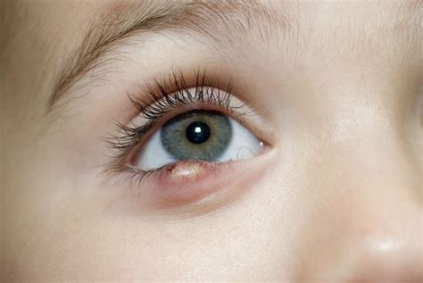 Stye Symptoms and Treatment in Children