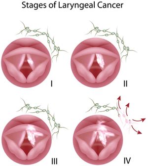 Laryngeal Cancer Surgery - Why Proper Documentation is Vital