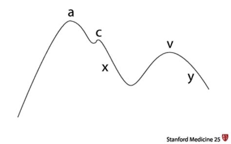 Jugular Venous Pressure Waveform