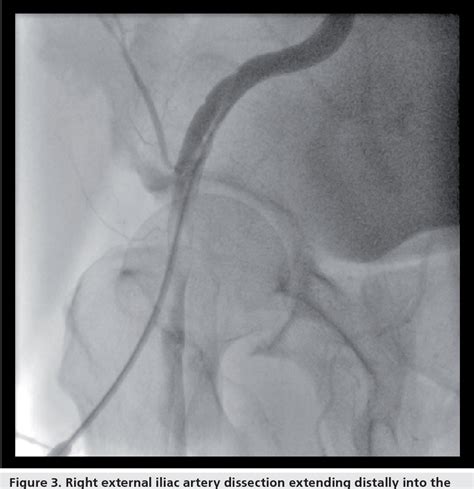 Femoral vascular access-site complications in the cardiac ...