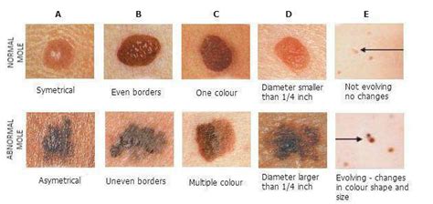 What is the ABCDE Rule of Skin Cancer: Outer Banks Dermatology: Board ...