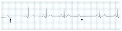 AV Block: 2nd degree, Mobitz II (Hay block) • LITFL • ECG Library