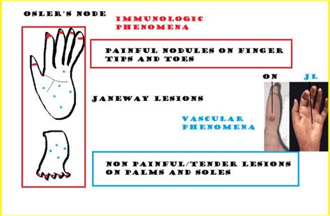 Osler Nodes and Janeway Lesions - SelahanceDonaldson