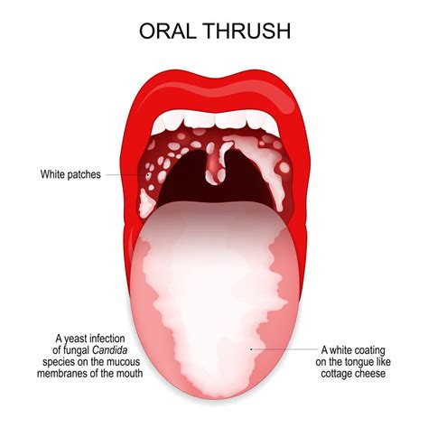 What Does Oral Thrush Look Like? (Pics & Symptoms)