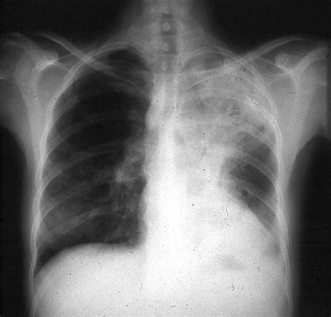 Blastomycosis in humans causes, symptoms, diagnosis and treatment