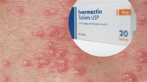 Scabies medicine available again after patients left waiting for months ...