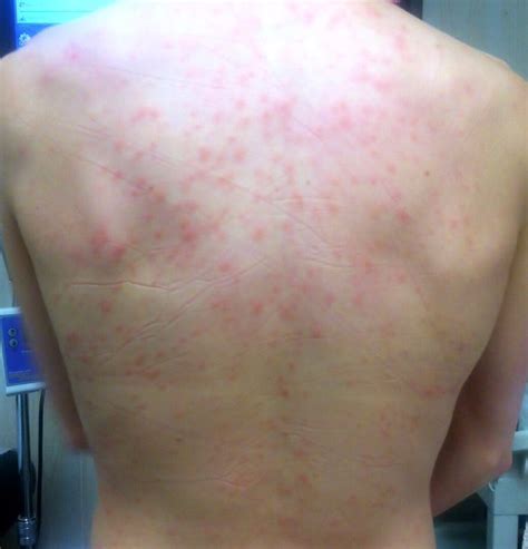 How Acupuncture treats Skin hives | Tao of Medicine