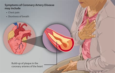 Coronary Artery Disease (CAD) - Physiopedia